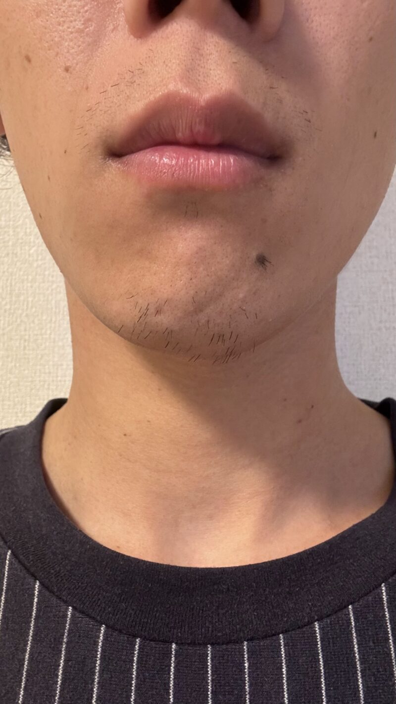 脱毛器効果