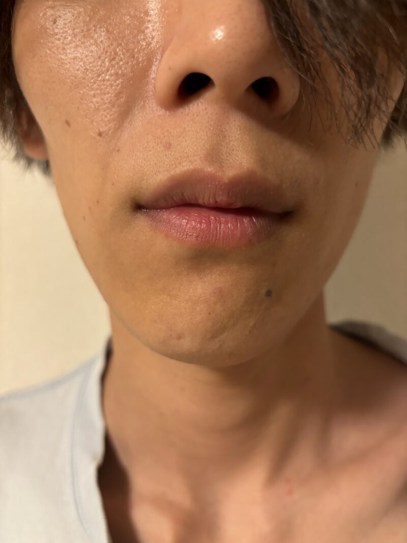 脱毛器効果